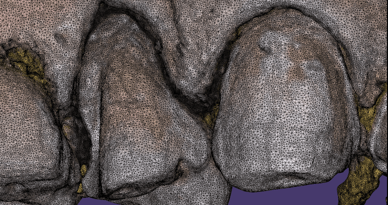 The Single Greatest Advantage of Digital Dentistry Over Analog Impressions