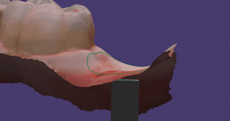 Digital Tissue Contouring in CAD-Ray Software Powered by exocad