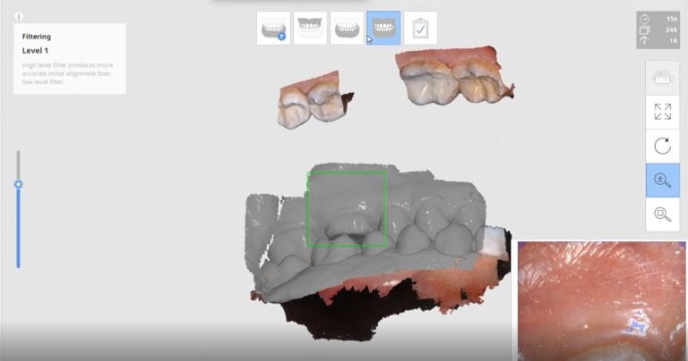 Advantage of Imaging the Buccal Bite before the Preparation