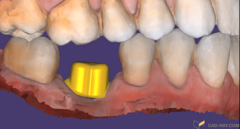 Why Restoring Implants Are The Most Predictable Restorative Procedures Dentists Can Perform, Thanks To Digital Dentistry