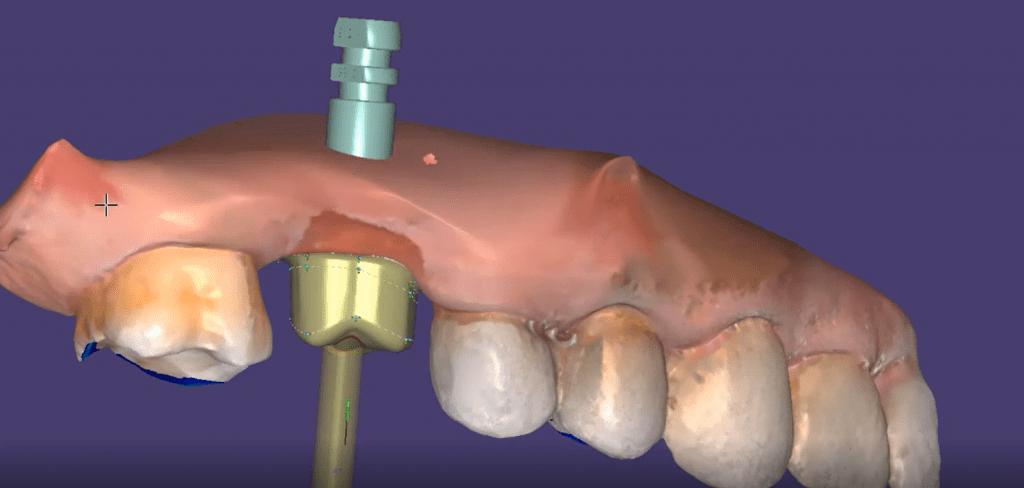 using digital dentistry scanning and design software for custom titanium abutment milling