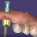 using digital dentistry scanning and design software for custom titanium abutment milling