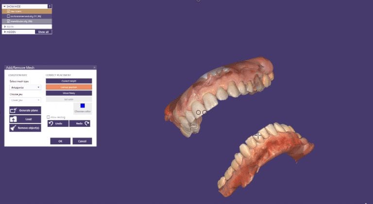 Hand Articulate Upper and Lower Jaw Models in Digital Manner with CAD-Ray Software Powered by exocad