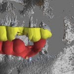 implant planning cad-ray