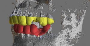 implant planning cad-ray