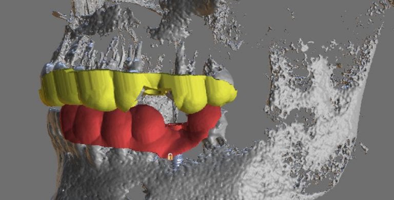 Implant Planning of Upper Second Premolar and Lower First Molar