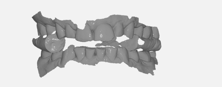 Occlusal Splint – Imaging With Medit i500 and Designed in exocad and Milled in Doowon Milling Machine