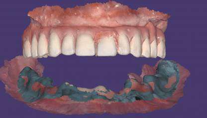 digital dental design CAD-RAY exocad edentulous arch