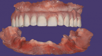 digital dental design for edentulous lower arch