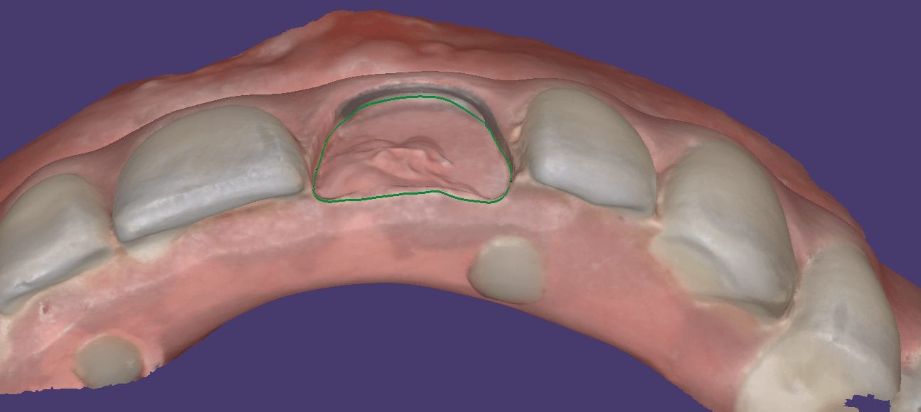 Fixing A Left Central Incisor On A Fixed Hybrid Bridge