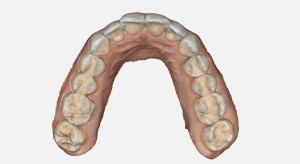digital dental scanning a full arch with great speed and accuracy