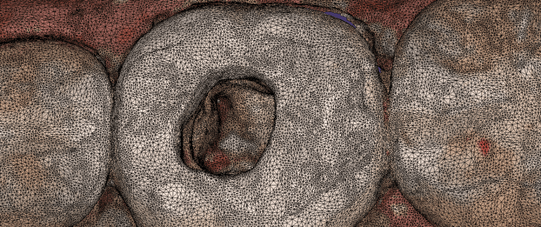 Imaging Inside the Canal of a Lower First Molar with the Medit i500