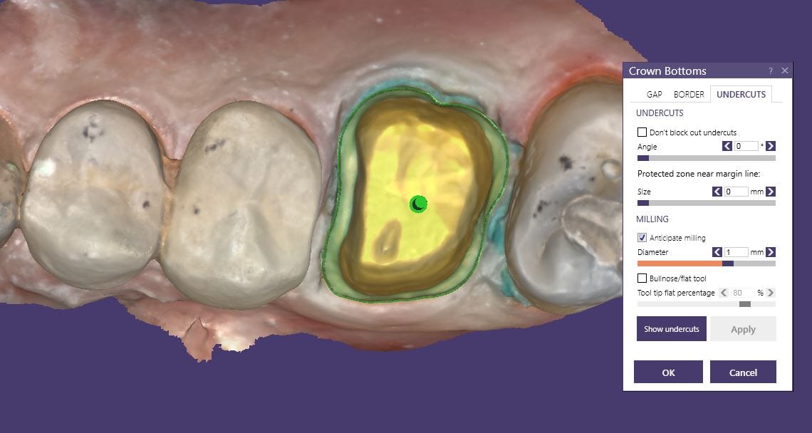 control over restoration fit of first molar with cad-ray exocad and imes icore milling