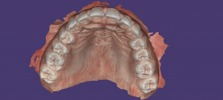 Digital Impressions for Immediate Dentures