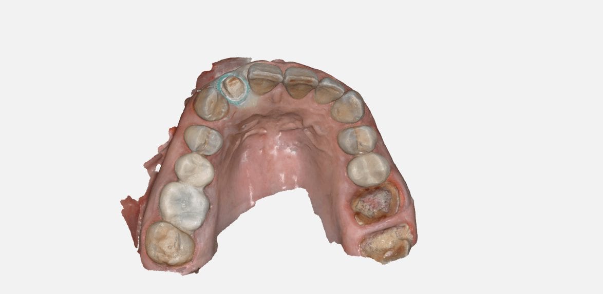 full arch scans with reliabilty map feature medit iscan software
