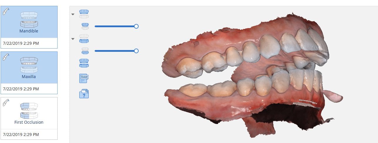 digital impressions capture open bite using own mouth as articulator