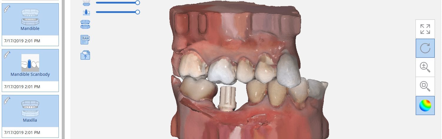 digital design exocad direct from medit i500 for custom abutment design