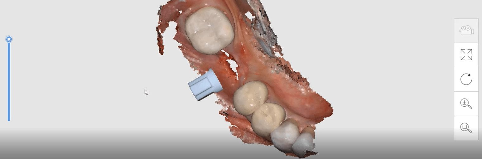 medit i500 digital implant scanbody feature