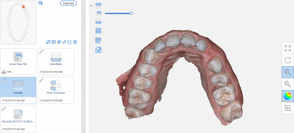 medit i500 used for implant planning in blueskybio software