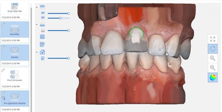 Marking Margins in Medit i500 Before Sending a Case to a Lab or CAD Software Like exocad