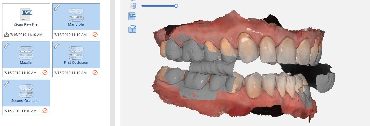 Two Buccal Bites for Occlusal Guard Fabrication