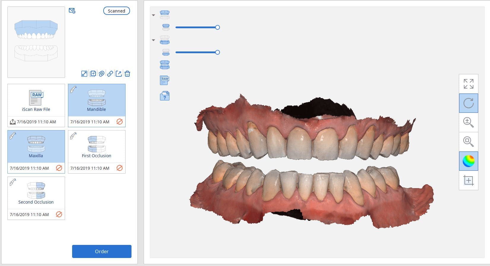 two buccal bites for occlusal guard fabrication