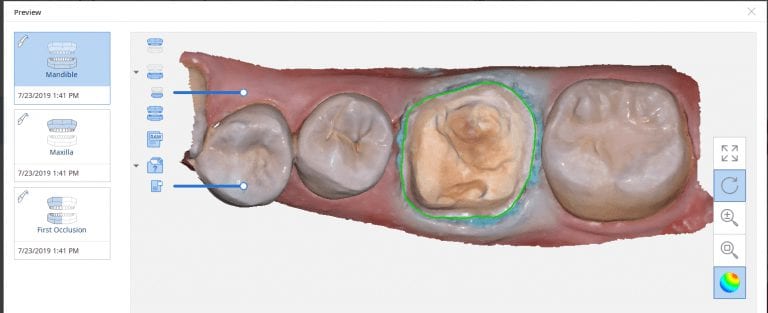First Molar Crown With Medit i500 Version 2.1 Beta, Design In exocad, And Milled With Imes Icore Cortitec One