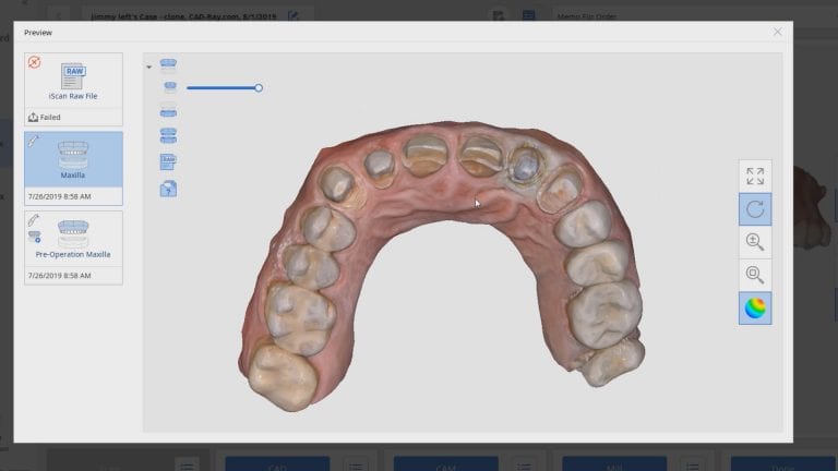 Six Anterior Units Scanned with Medit i500 to Produce eMax Restorations on Printed Models