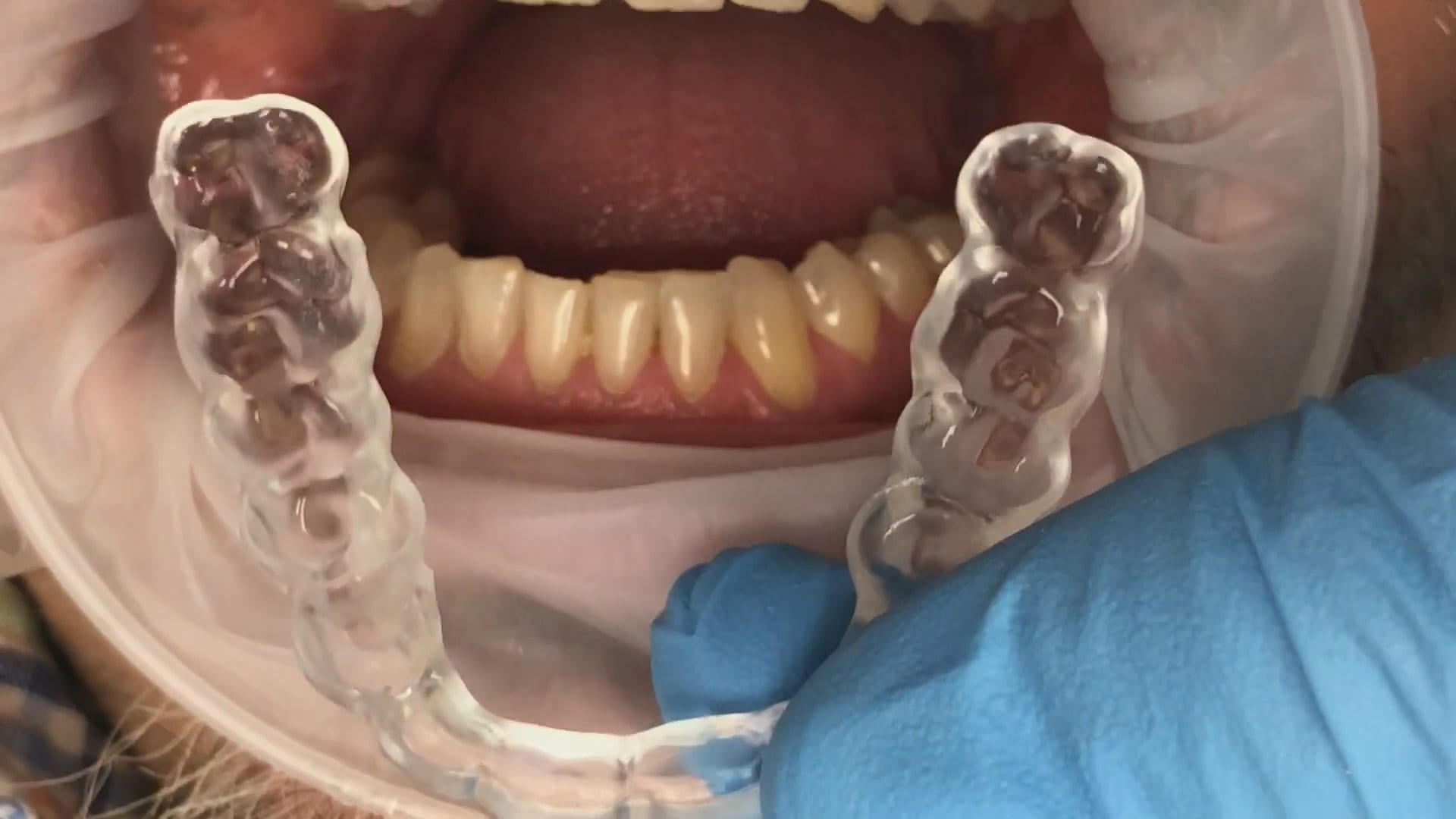 two buccal bites imaging no adjustments on occlusal guard