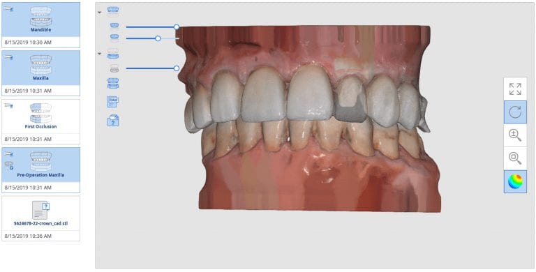 Anterior Copy Crown With Medit i500 Direct Import Into CAD for Design and Mill with CEREC MCXL and CORiTEC ONE