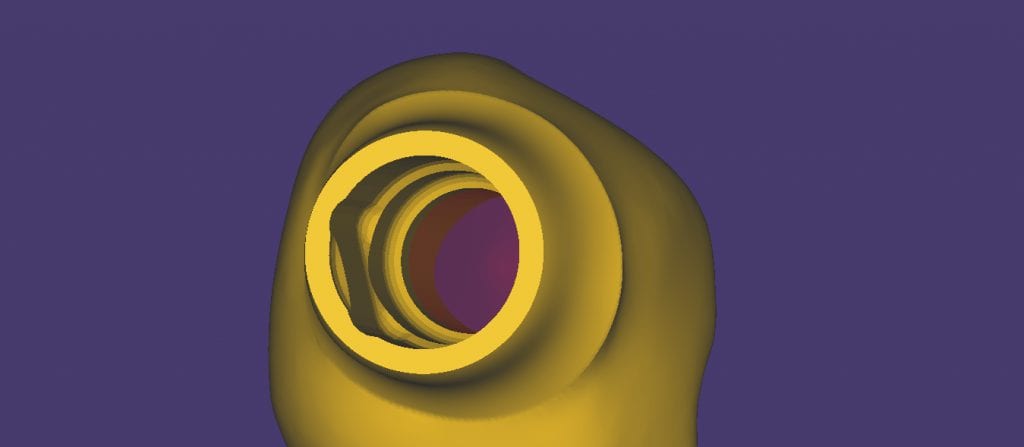 milling to a tibase from a scanbody impression