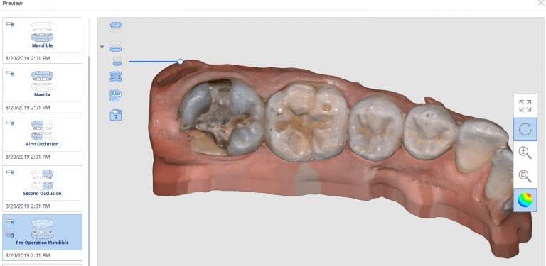 Full Coverage Crown on a Fractured Second Molar and Two Bites