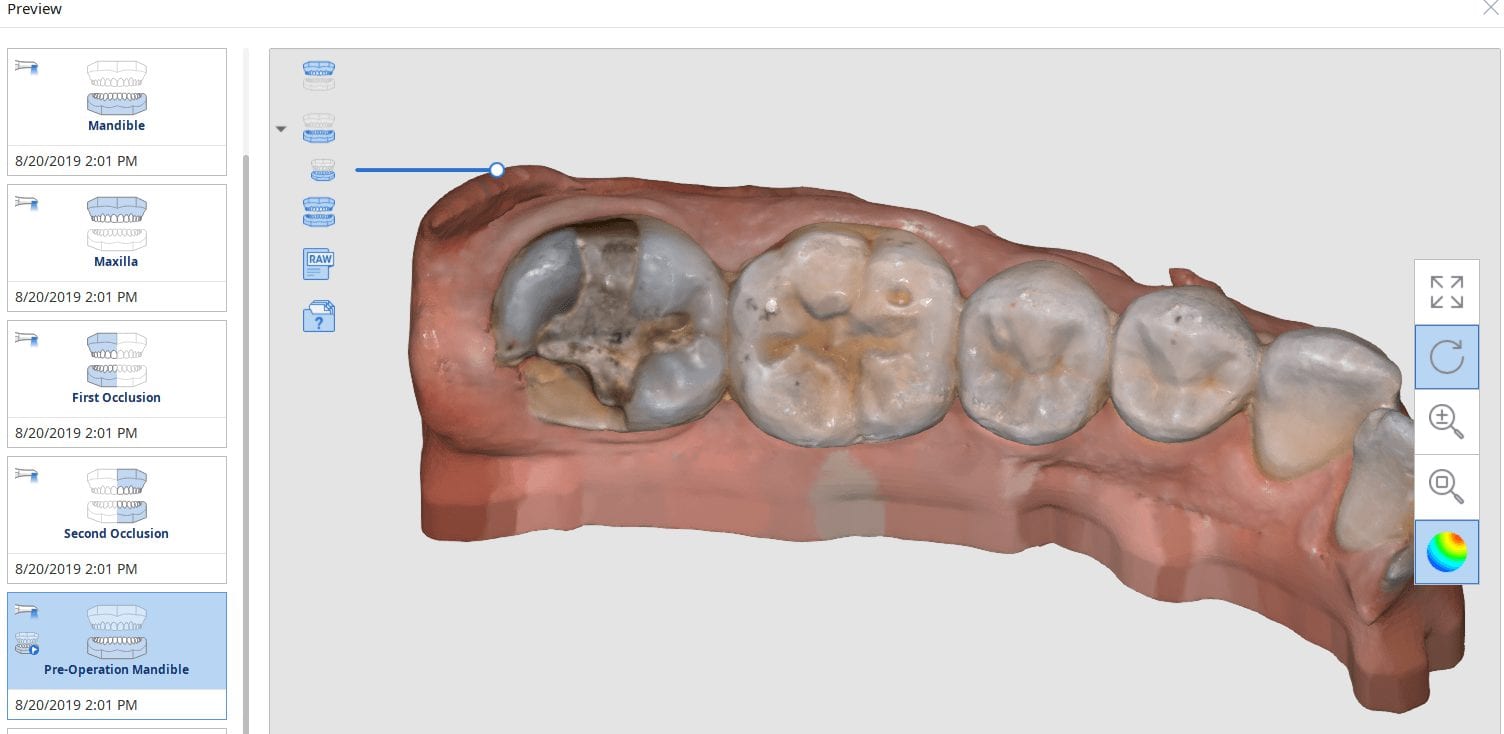 capturing two bites for fractured second molar