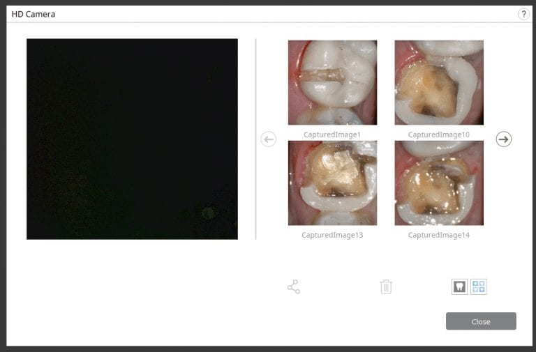 How to Cut Off a Bonded Ivoclar eMax Restoration