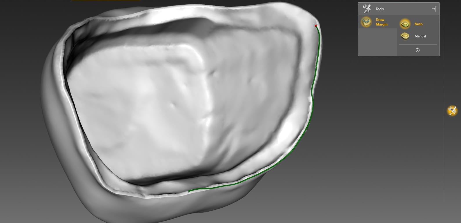 cerec mcxl margin design