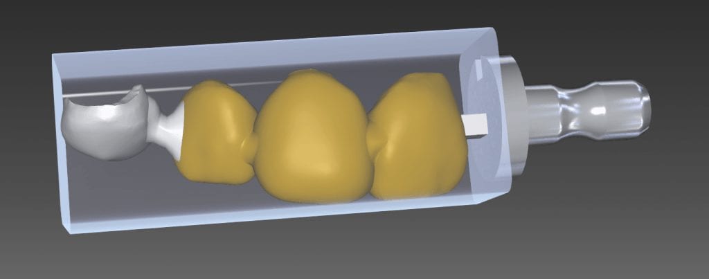 three unit bridge and single unit vaneer milled