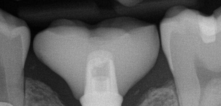Tired of Nuclear or Atomic Mushroom Bomb Cloud Shaped Abutment Crowns?