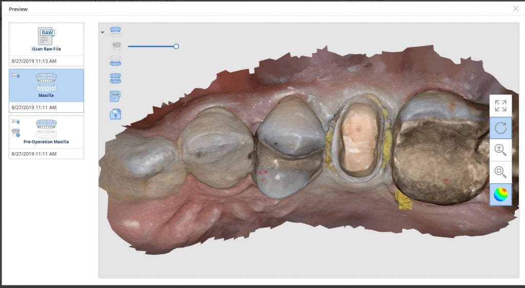 medit i500 manage crown replacement on second upper molar