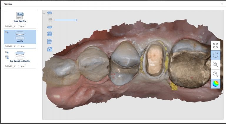 Premolar Anatomic Copy Case with Medit i500, exocad, and imes icore eMax Milled Restoration