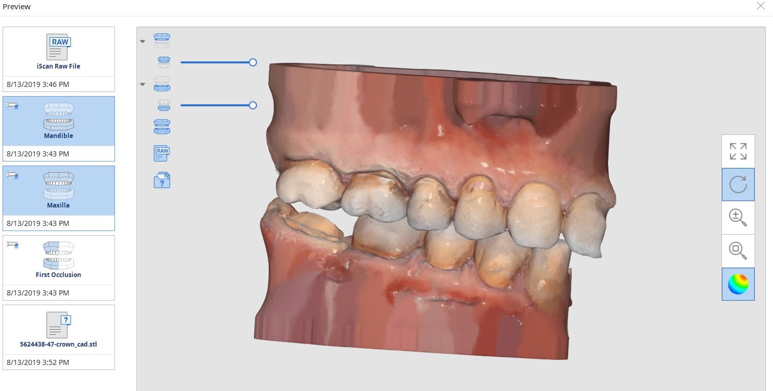 protocol to reduce surprises and post op adjustmenst second molar restoration