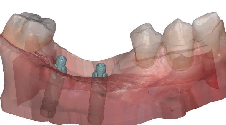 Automatic Scanbody Detection and Auto-Import Into Exocad and Immediate Fixture Identification