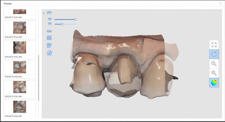 Premolar Crown Replacement with Medit i500 and CORiTEC ONE