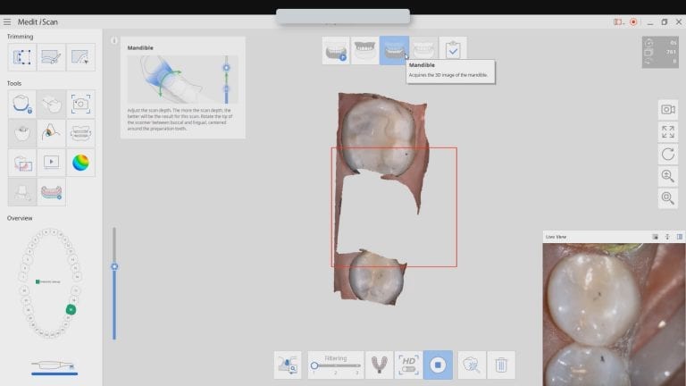You Need Enough Redundant Data Between The Pre-op and Prep Models To Activate Image Aquisition