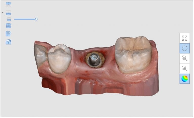 Hemostatis Allows for Easy Imaging of Margins on a Direct Abutment