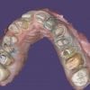 full arch scans with Medit i500