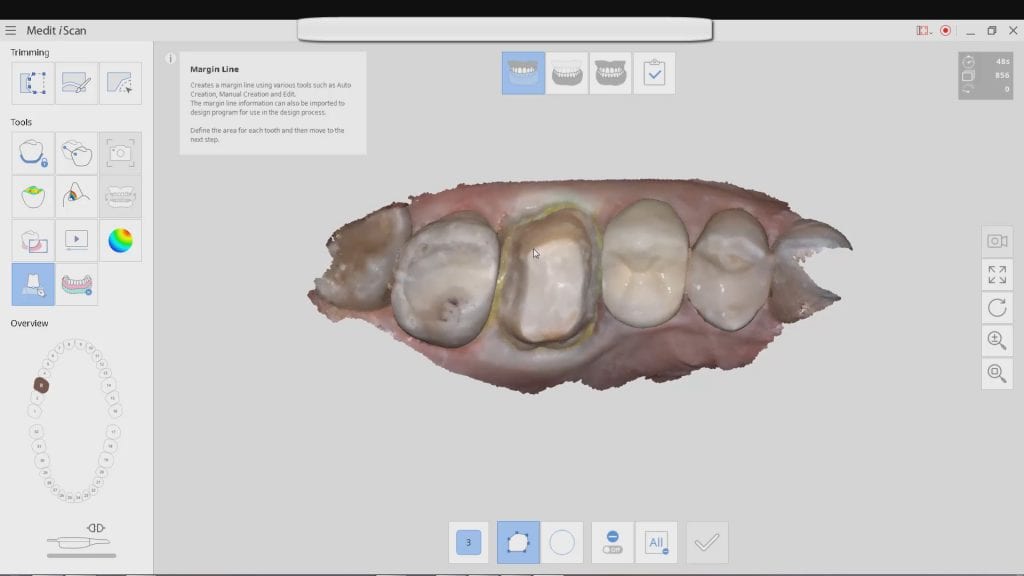 margin placement with Medit i500 Intra-Oral Scanner