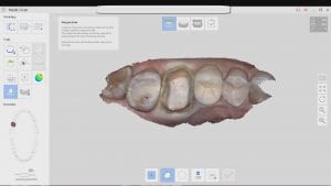 margin placement with Medit i500 Intra-Oral Scanner