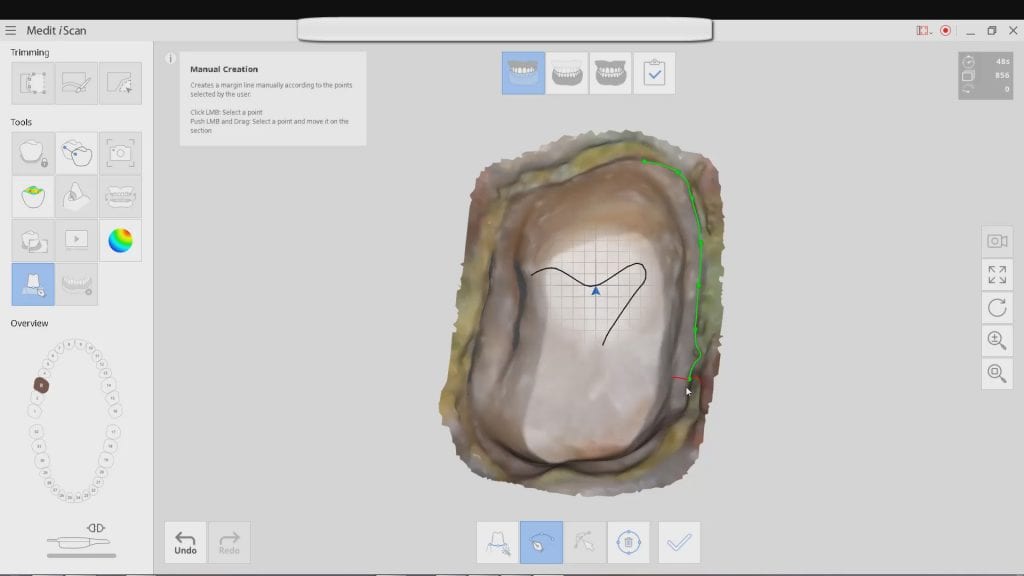Medit i500 Intra-Oral Scannerallows magins marking in its native software