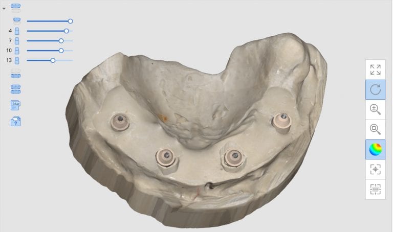 Using Medit’s Artificial Intelligent Implant Suprastructure Identification System to assess the accuracy of a cross arch digital impression!