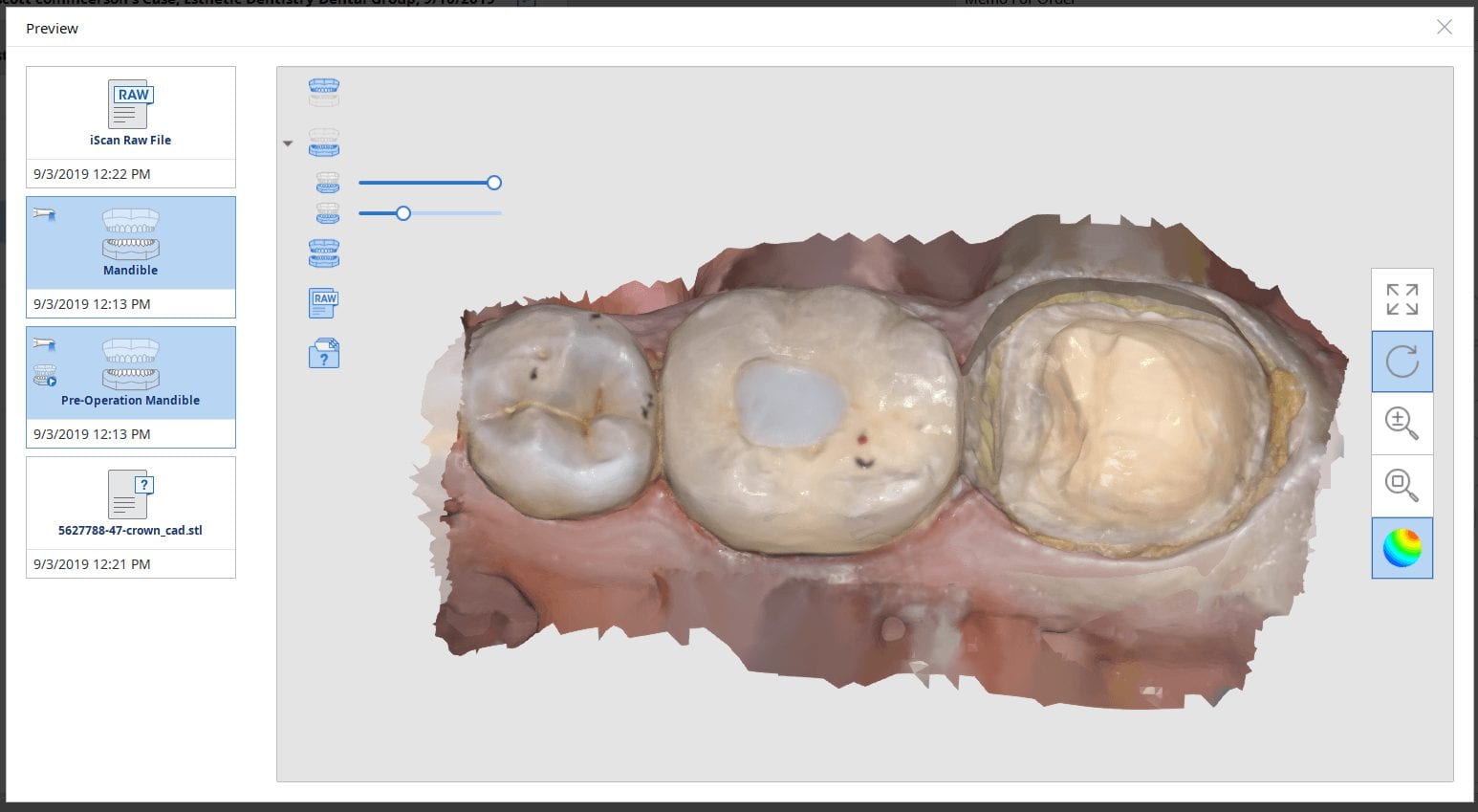 crown replacement using medit i500 to mark margins